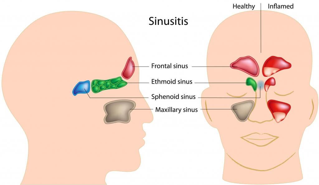 Sinus and facial pain