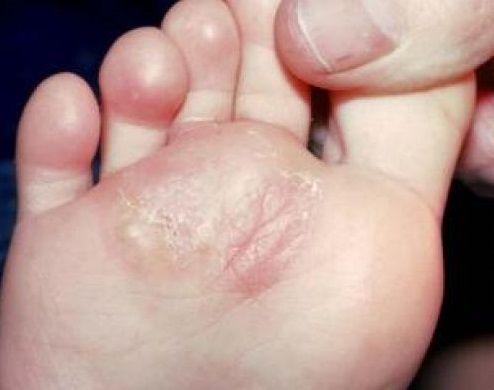 best of Blister bottom foot on Water of